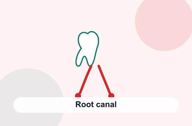 Root canal treatment overview image